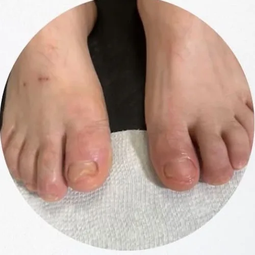 Care for thickened, discolored toenails. — After