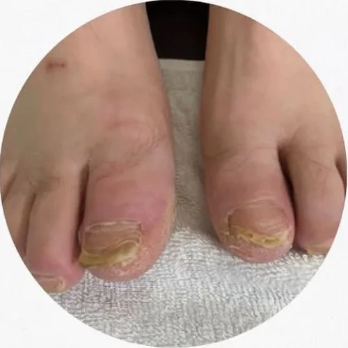 Care for thickened, discolored toenails. — Before