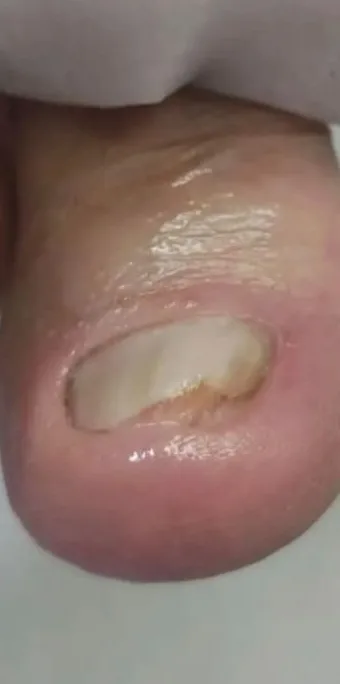 Care for a thickened, deformed toenail (onychogryphosis). — After